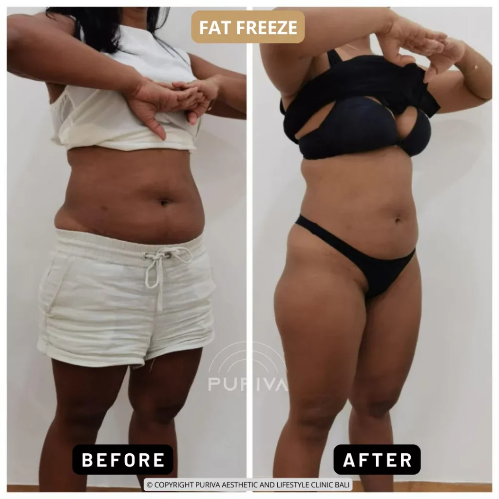 Before and after cryolipolysis