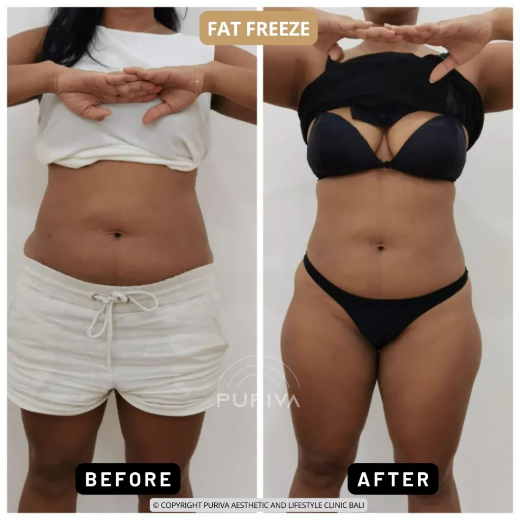Before and after cryolipolysis